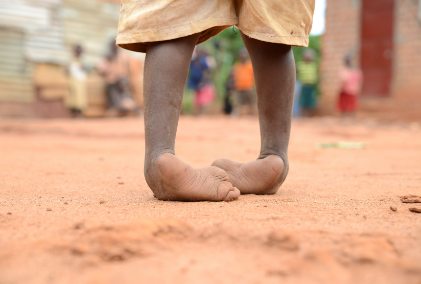 Il piede torto di Rebecca