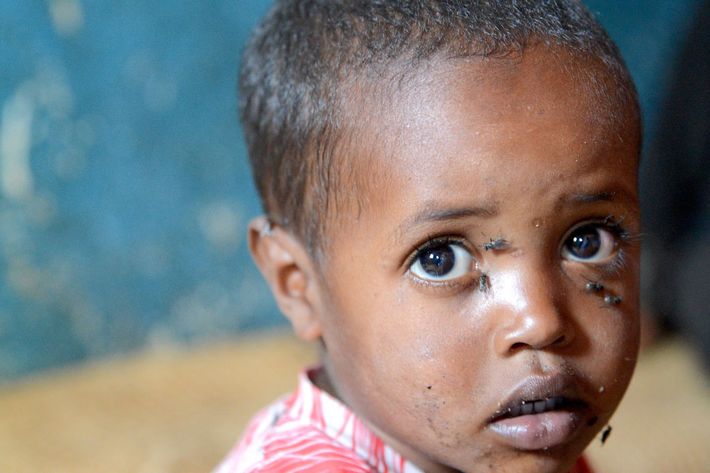 bambino etiope con tracoma